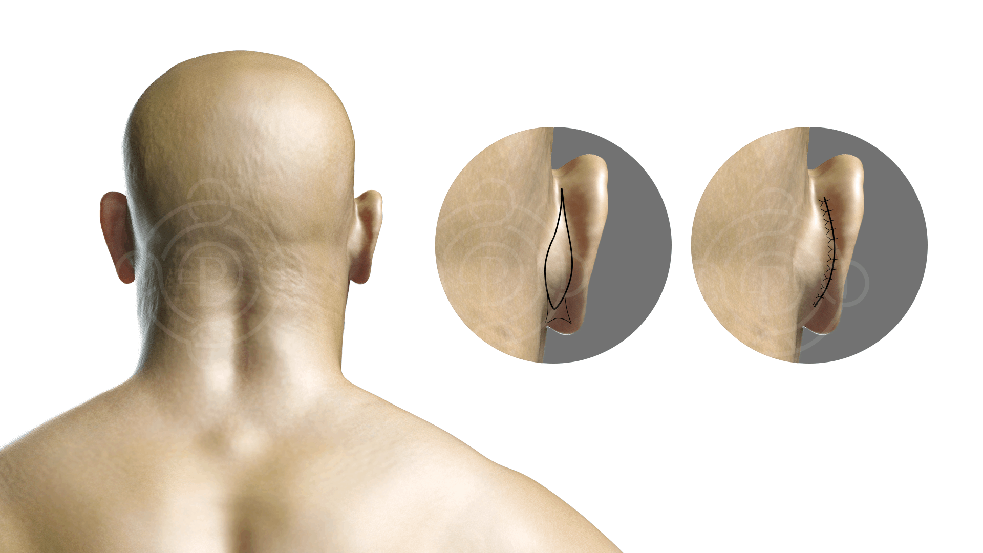 otoplasty incisions hidden behind ear