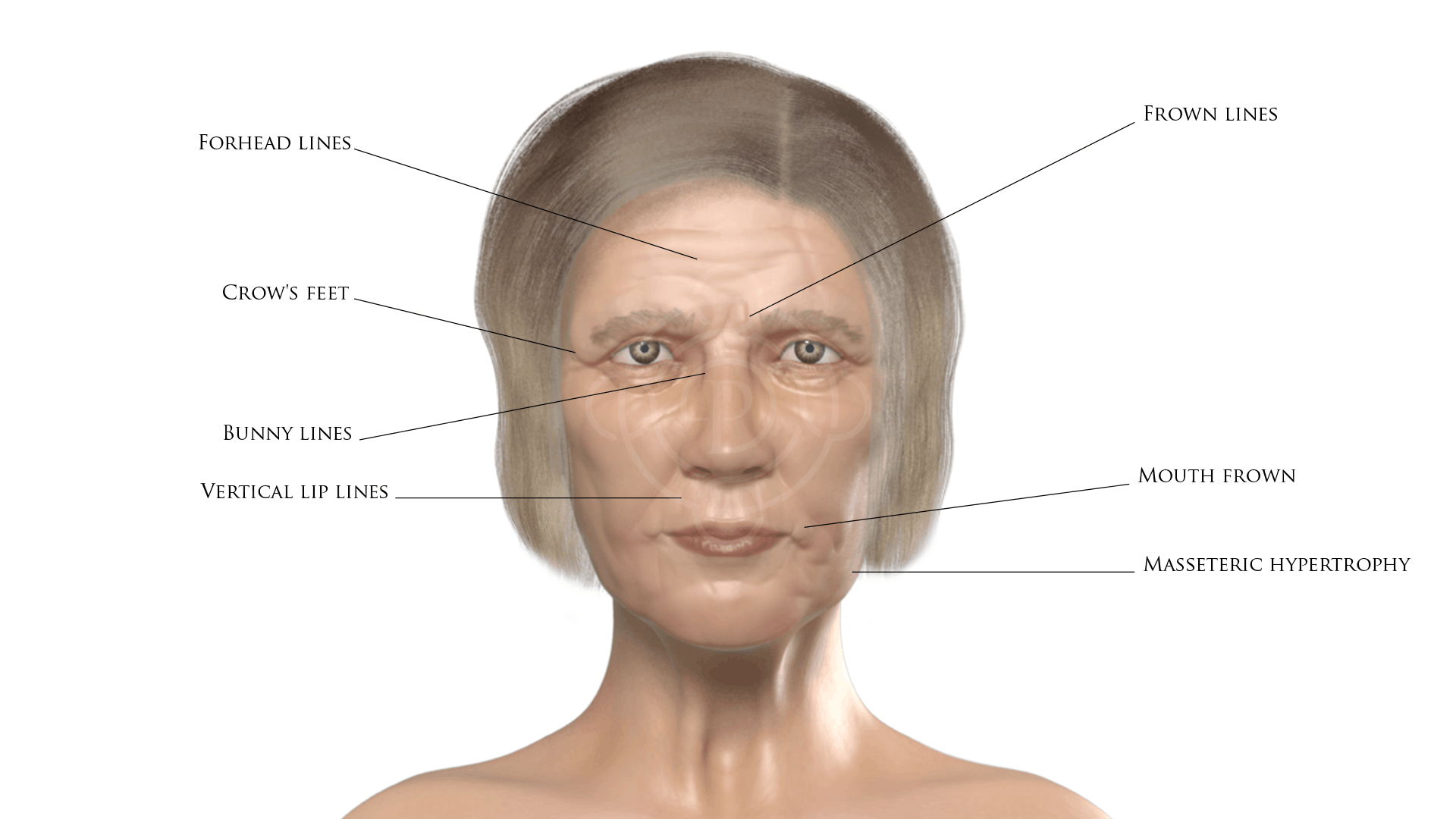 Botox for Forehead Line, Frown Lines, Crow's feet, Bunny Lines, Vertical Lip Lines, Mouth Frown, Masseteric Hypertrophy