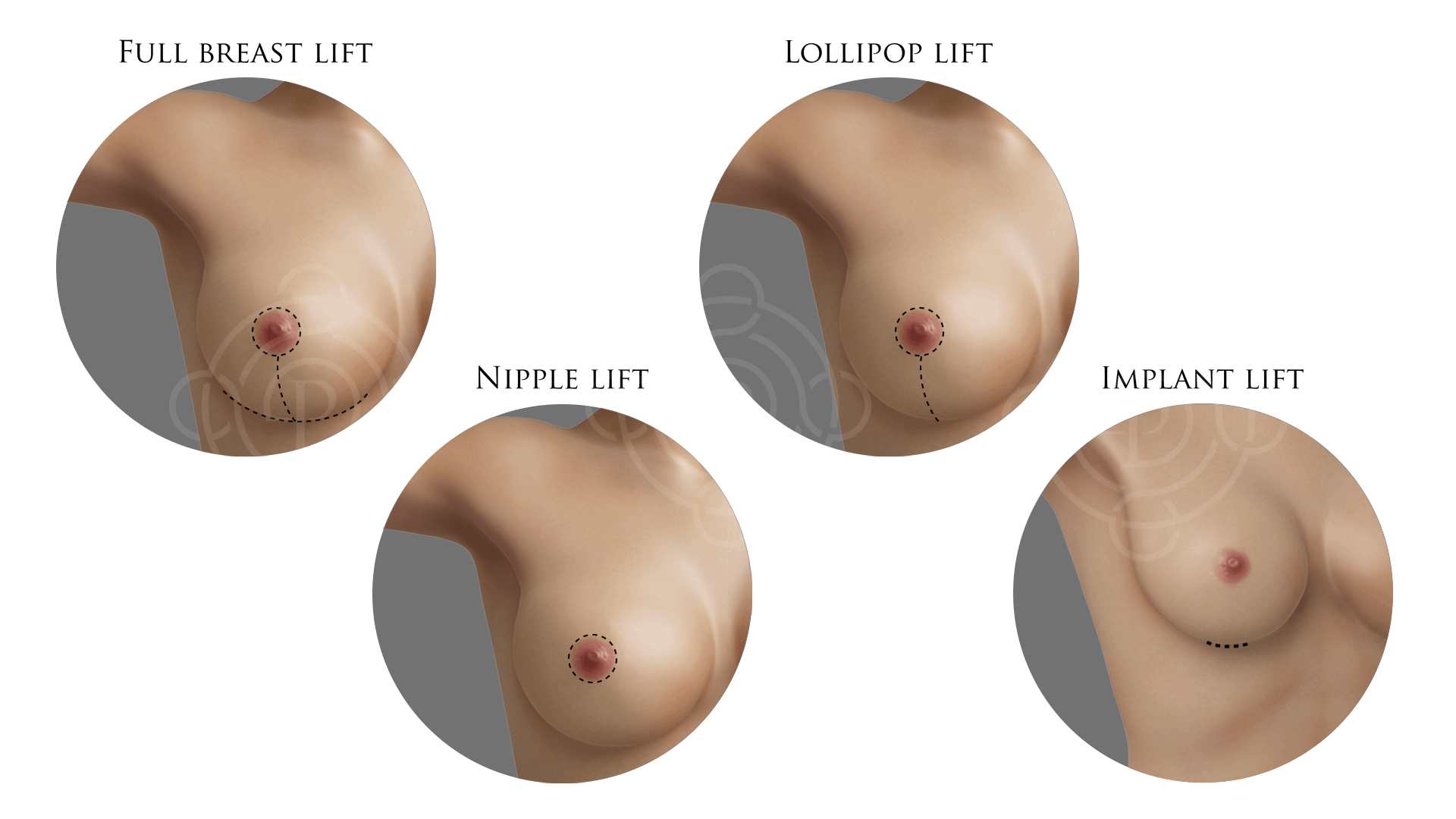 Full Breast Lift, Lollipop Lift, Nipple Lift and Implant Lift Incisions