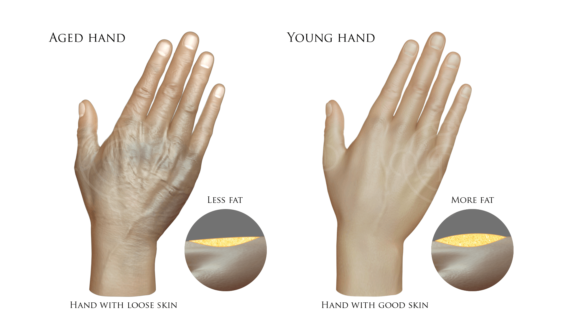 Hand Rejuvenation : Aged Hand with Loose Skin and Less Fat vs Young Hand with Good Skin and More Fat
