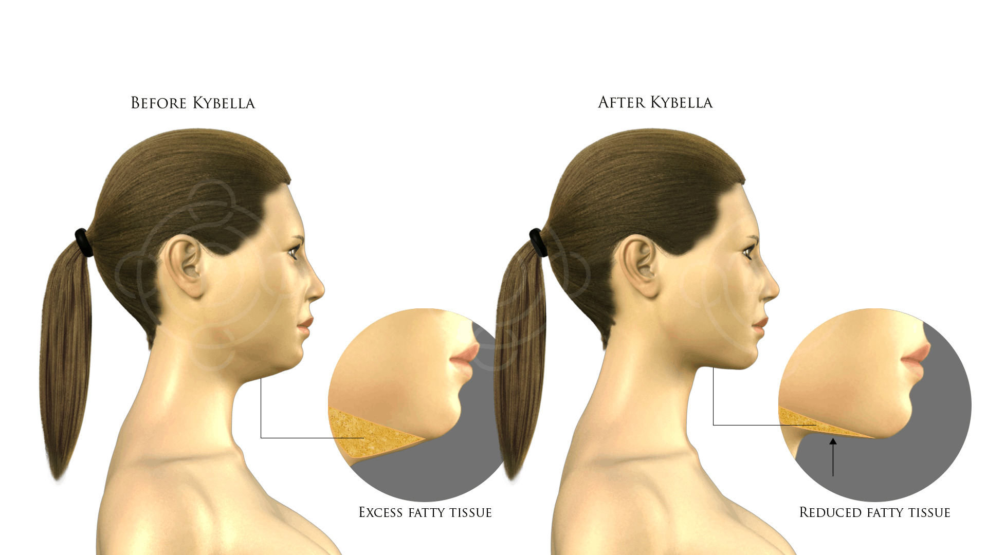 Chin before and after Kybella treatment