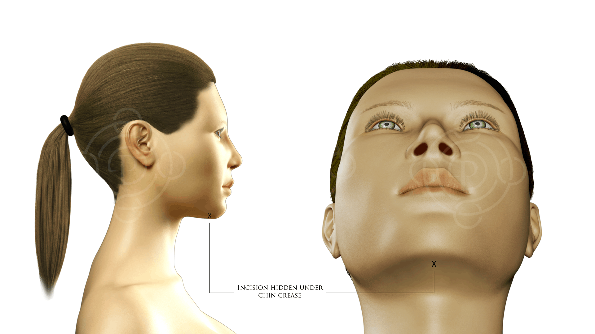 Neck Liposuction Incision Hidden Under Chin Crease