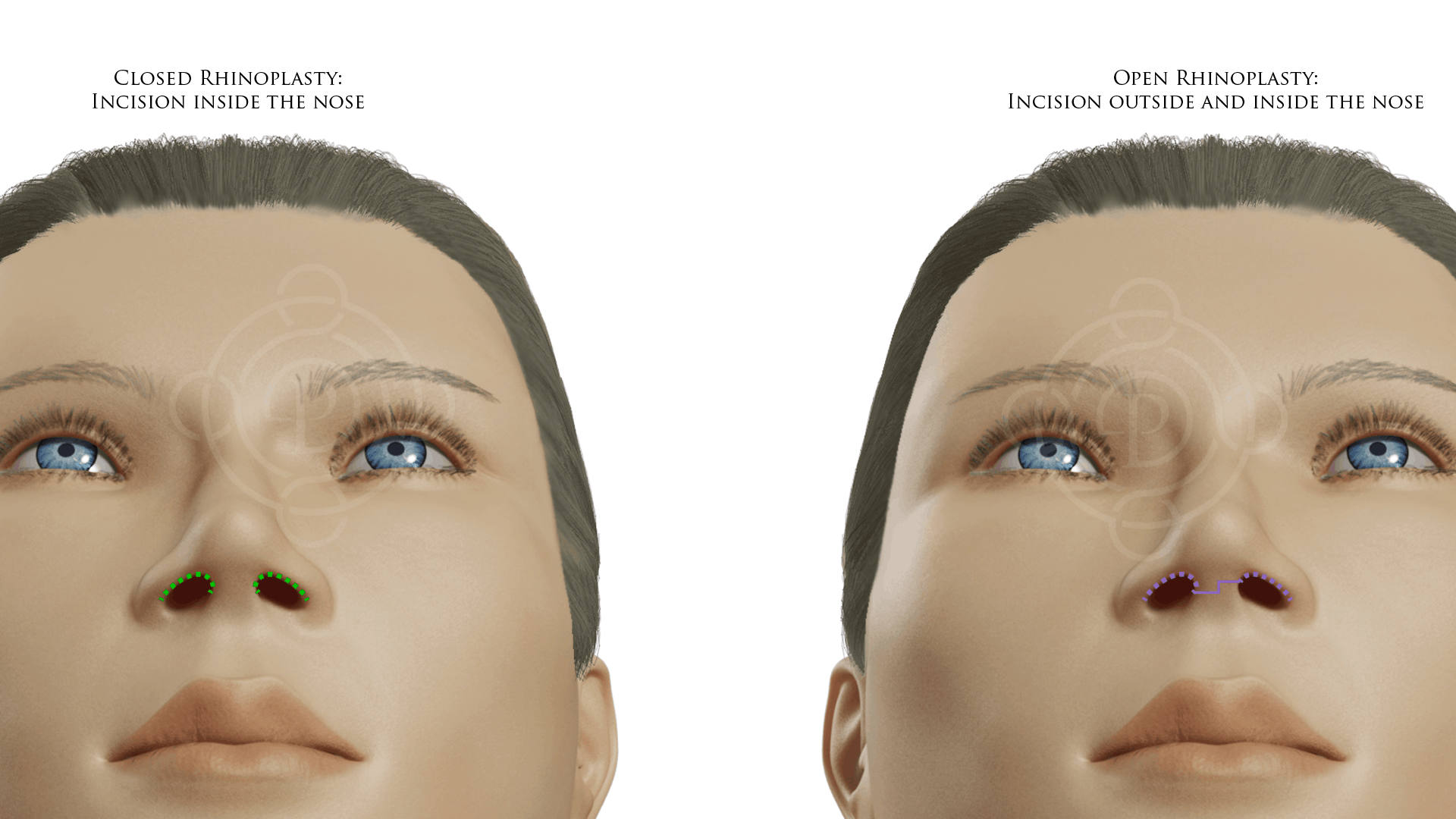 Closed Rhinoplasty: Incision Inside the Nose vs Open Rhinoplasty: Incision Outside and Inside the Nose