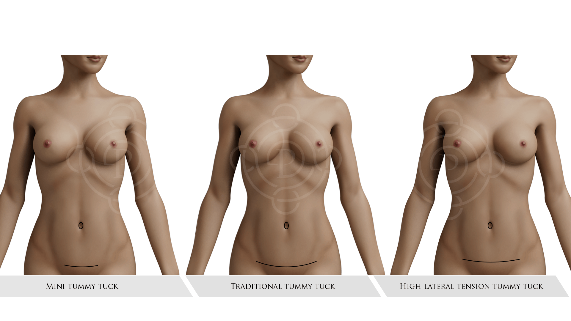 Mini, Traditional and High Lateral Tension Tummy Tuck Incisions