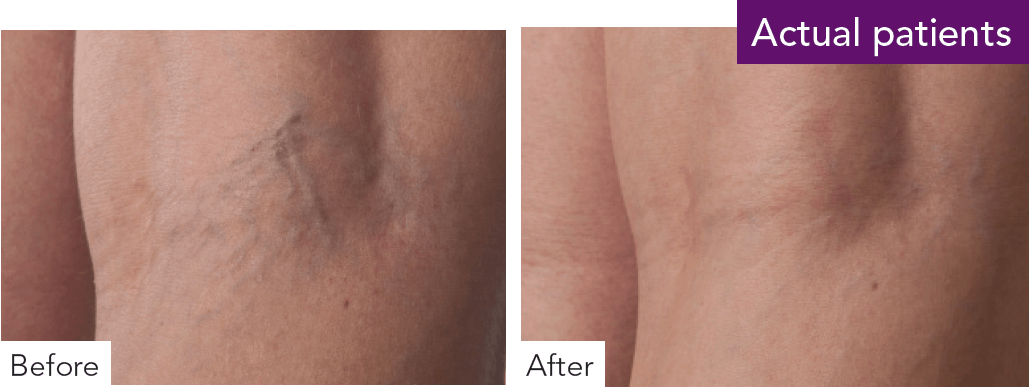 Patient's leg before and after reticular veins treatment.