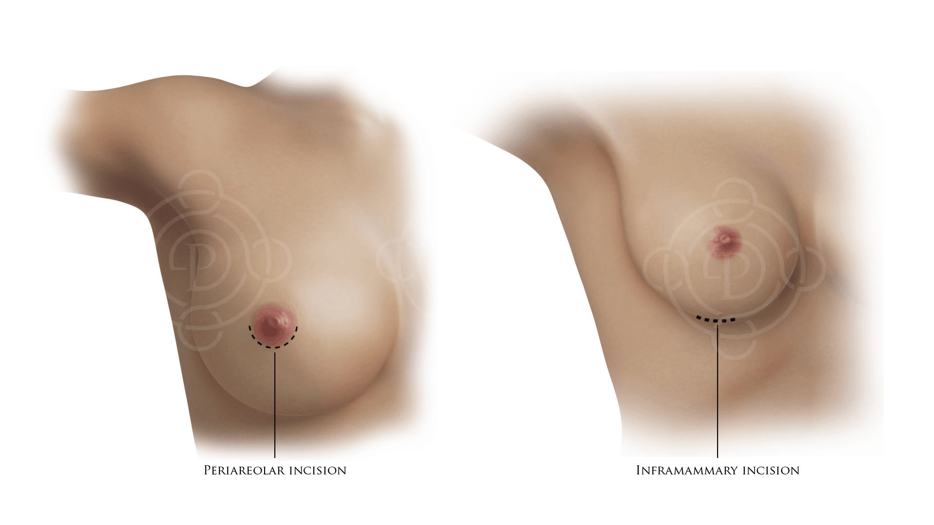 Periareolar Incision and Inframammary Incision