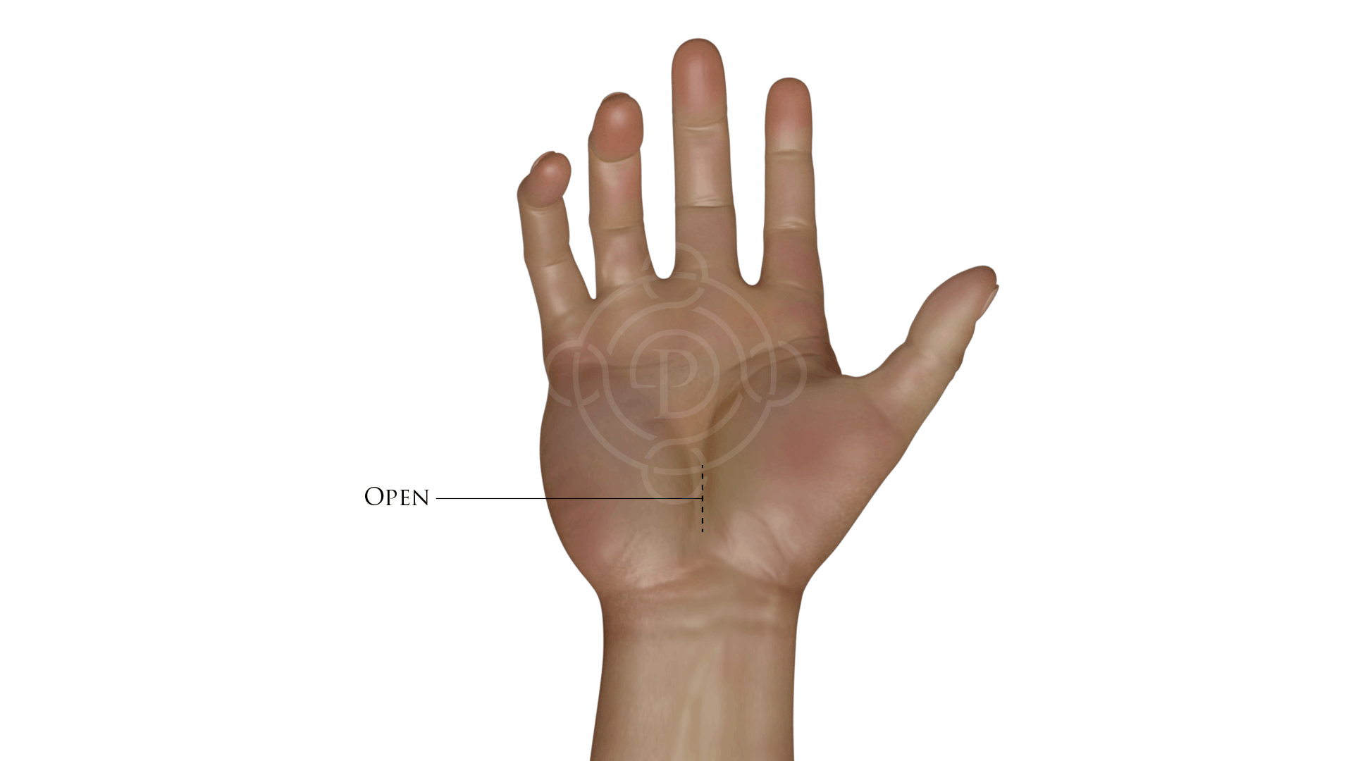 Open Incision for Carpal Tunnel Treatment Procedure