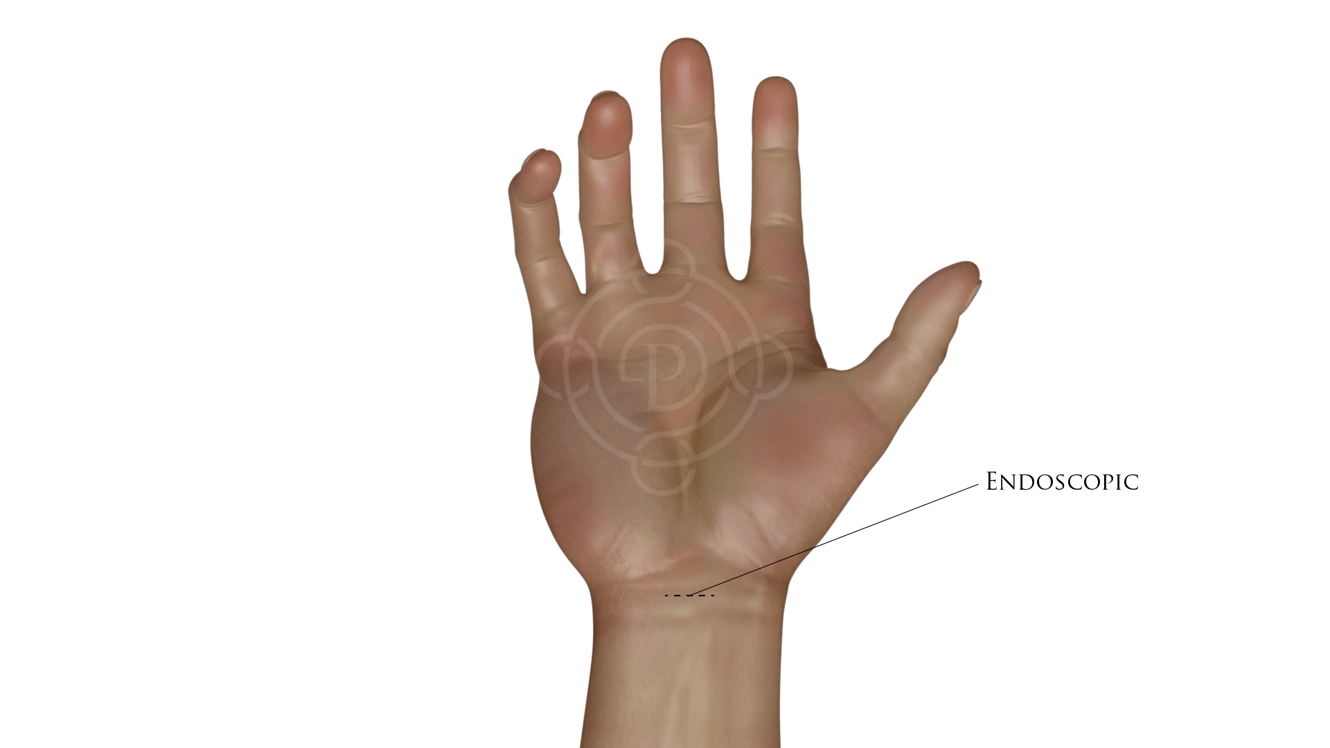Incision for Carpal Tunnel Treatment Endoscopic Procedure