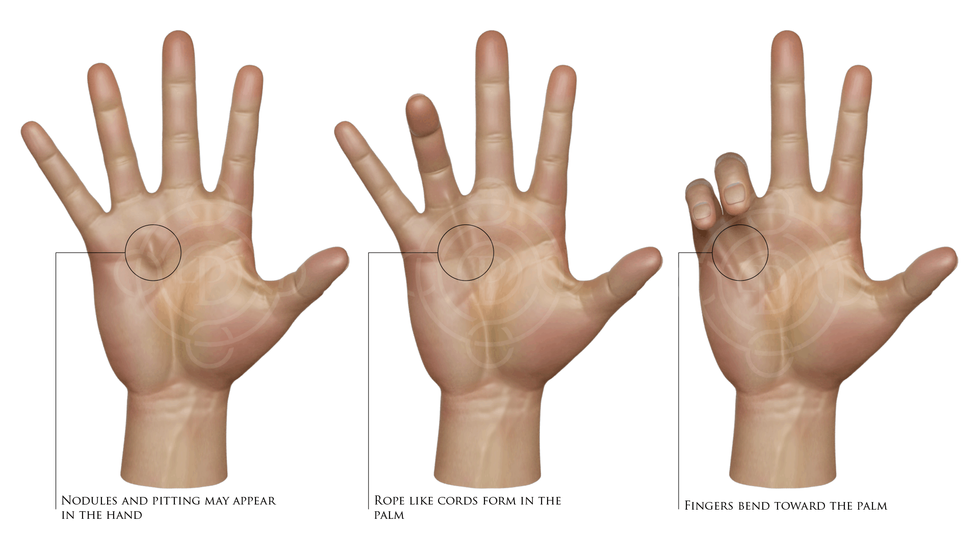 Depuytrens Disease: Nodules and Pitting May Appear in the Hand, Rope Like Cords Form in the Palm, Fingers Bend Toward the Palm
