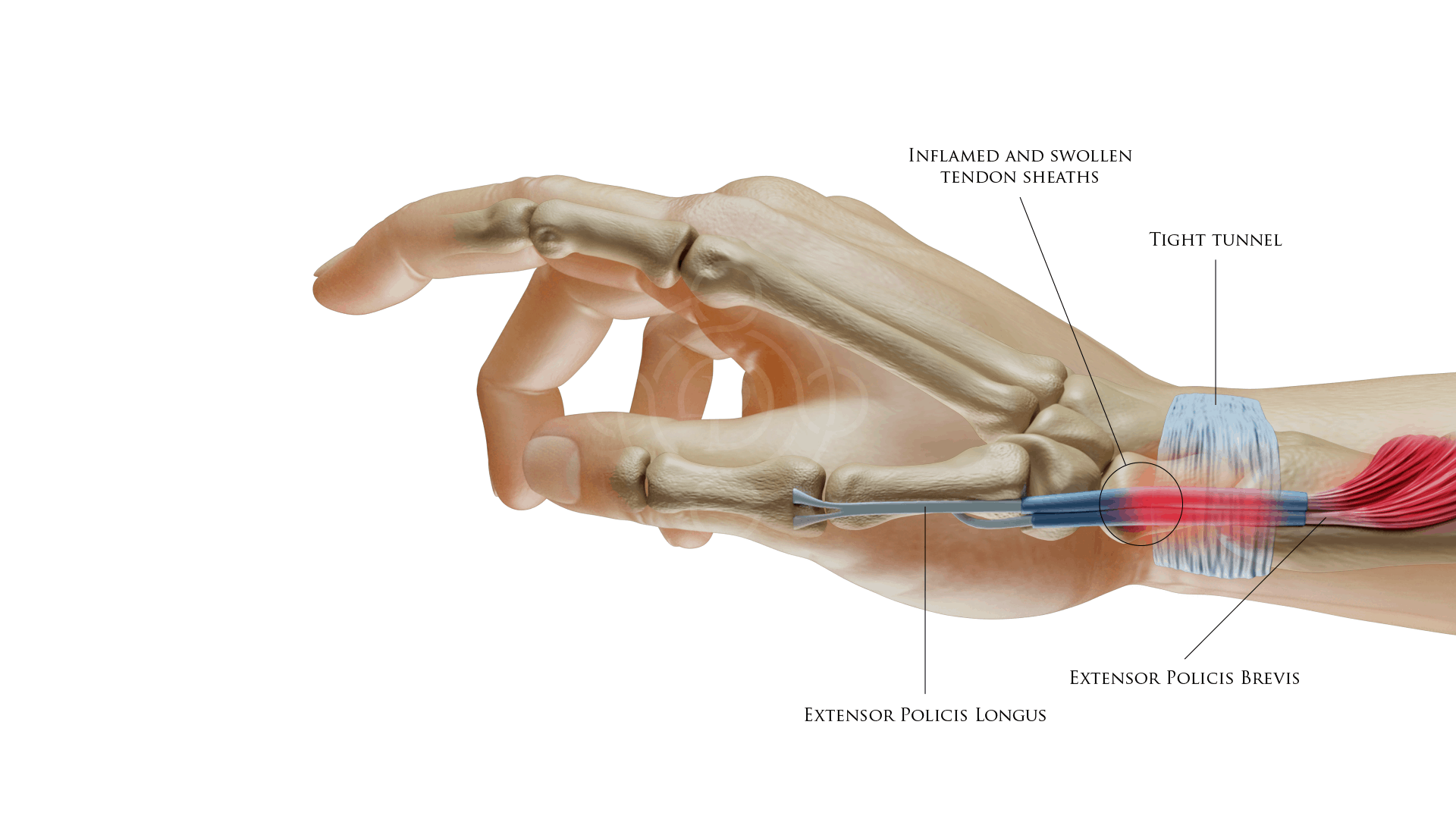 DeQuervain's Tenosynovitis: Inflamed and Swollen Tendon Sheaths, Tight Tunnel