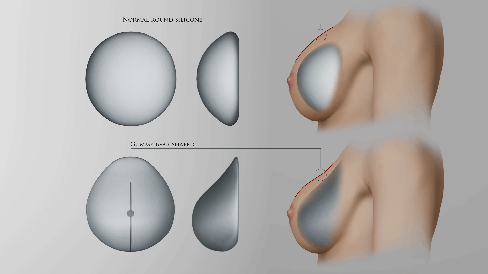 Normal round silicone breast implant and gummy bear shaped implant.