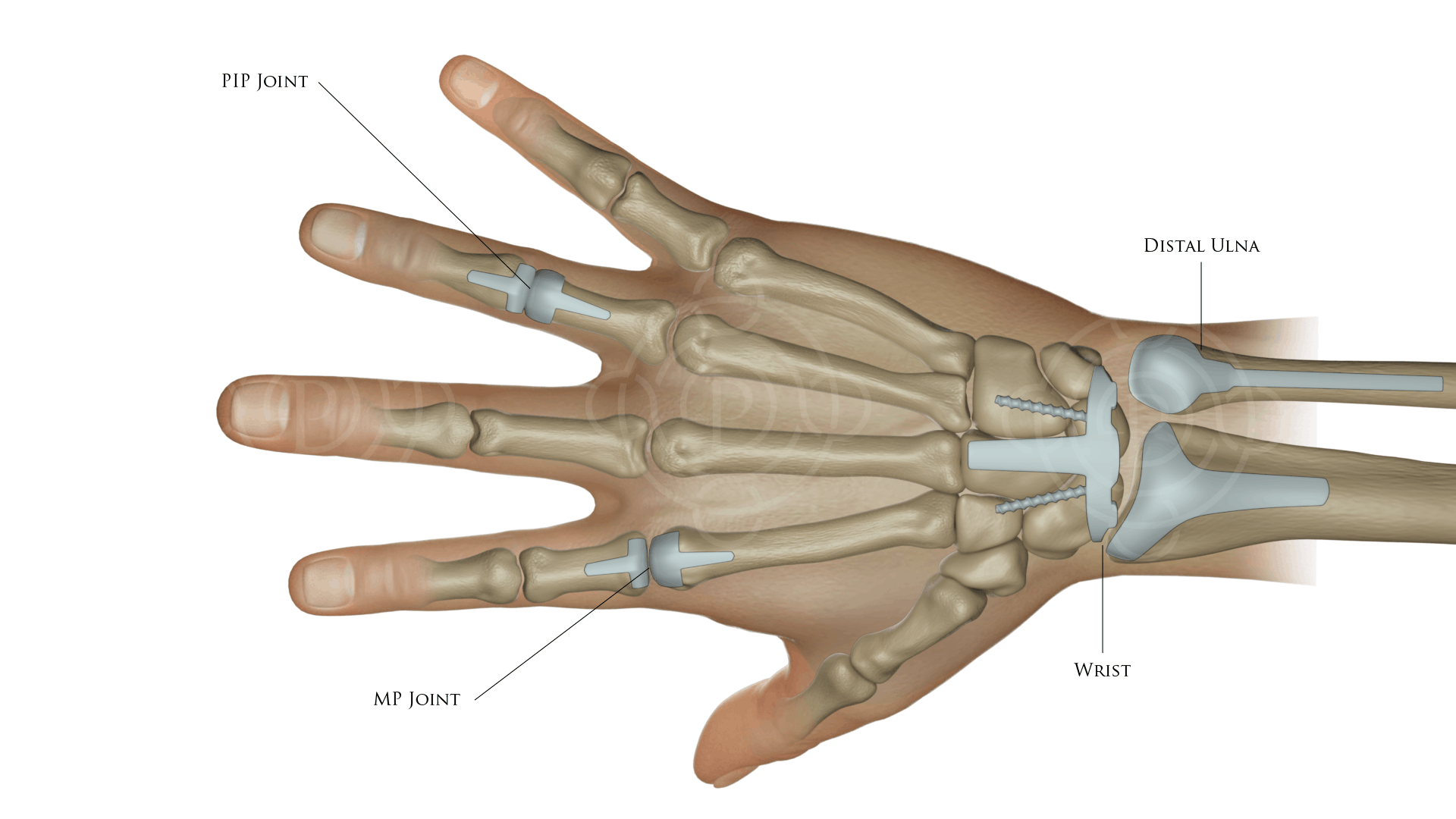 PIP Joint, MP Joint, Distal Ulna, Wrist