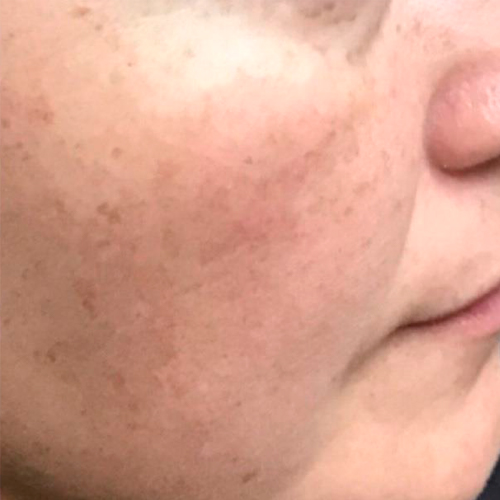 Patient's face after Pico Laser skin treatment.