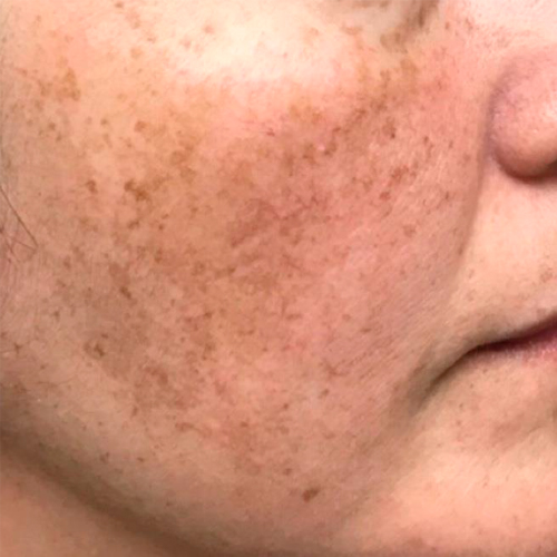 Patient's face before Pico Laser skin treatment.