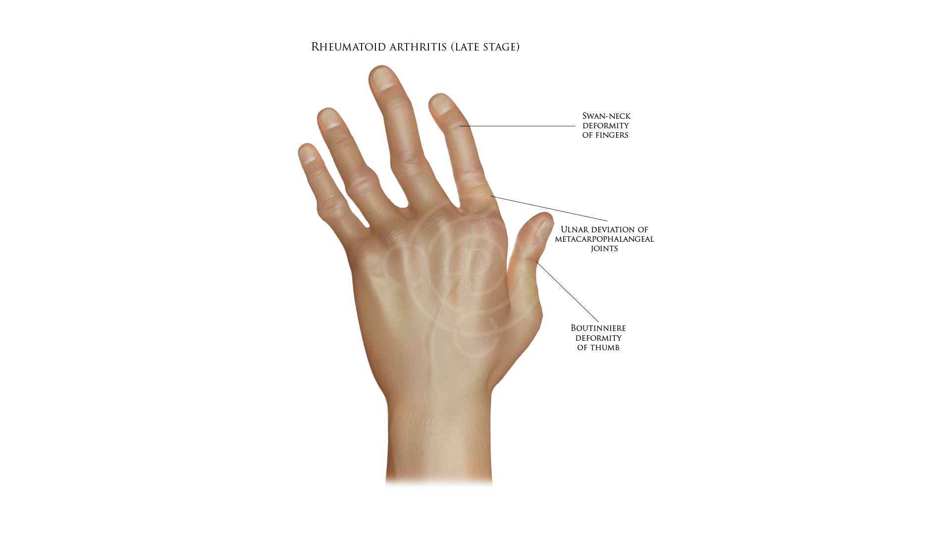 hand rheumatoid arthritis at late stage