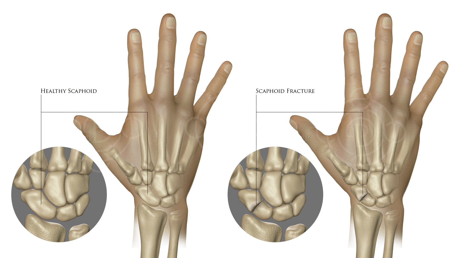 Healthy Scaphoid and Scaphoid Fracture
