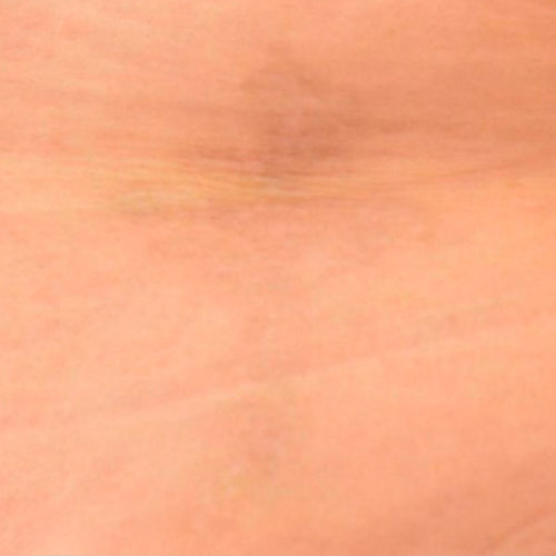 Patient after tattoo removal with Pico Laser.