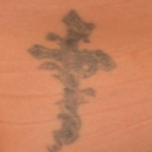 Patient before tattoo removal with Pico Laser.