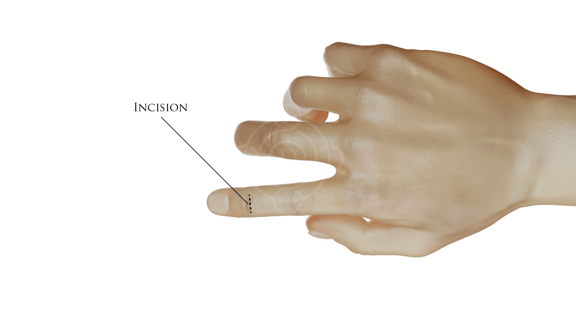 Finger procedure incision