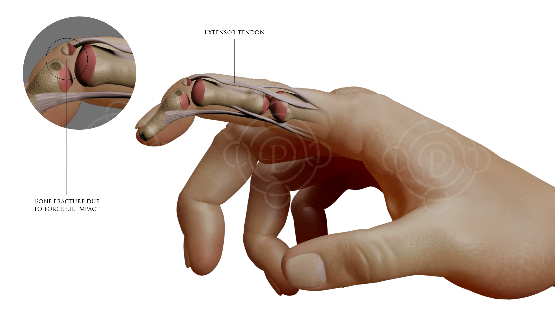 Mallet Finger Fracture: Bone Fracture Due To Forceful Impact , Extensor Tendon