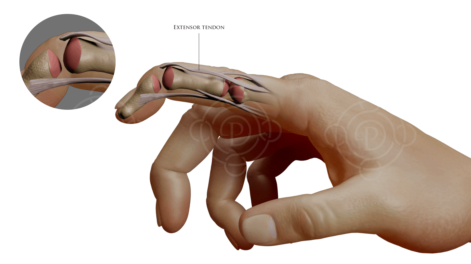 Mallet Finger Fracture: Extensor Tendon