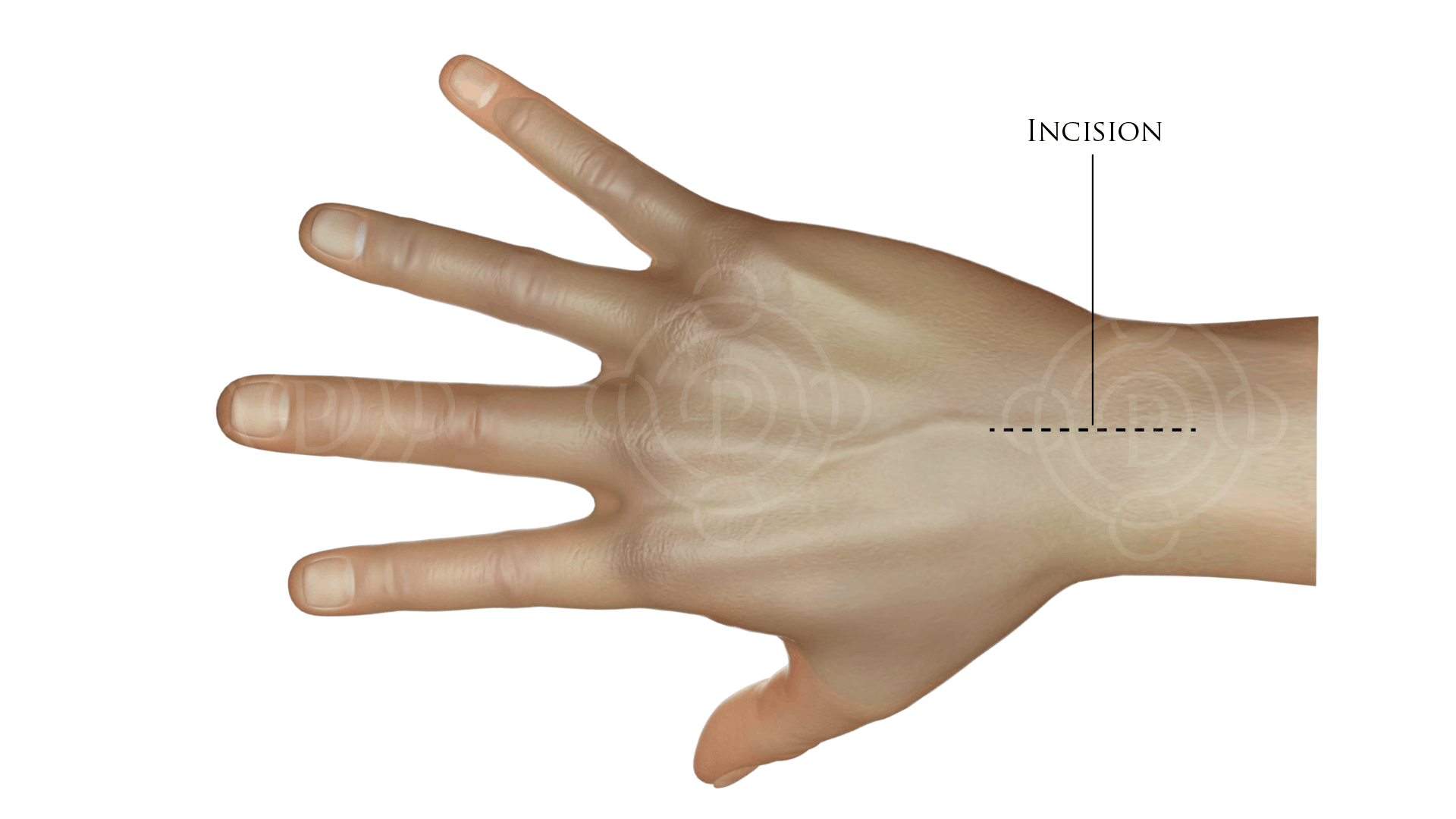 incisions for wrist joint procedure