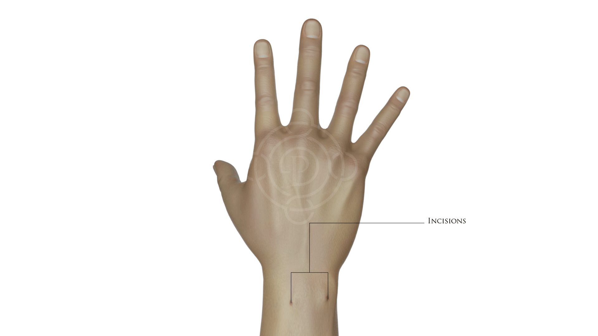 wrist arthroscopy incision