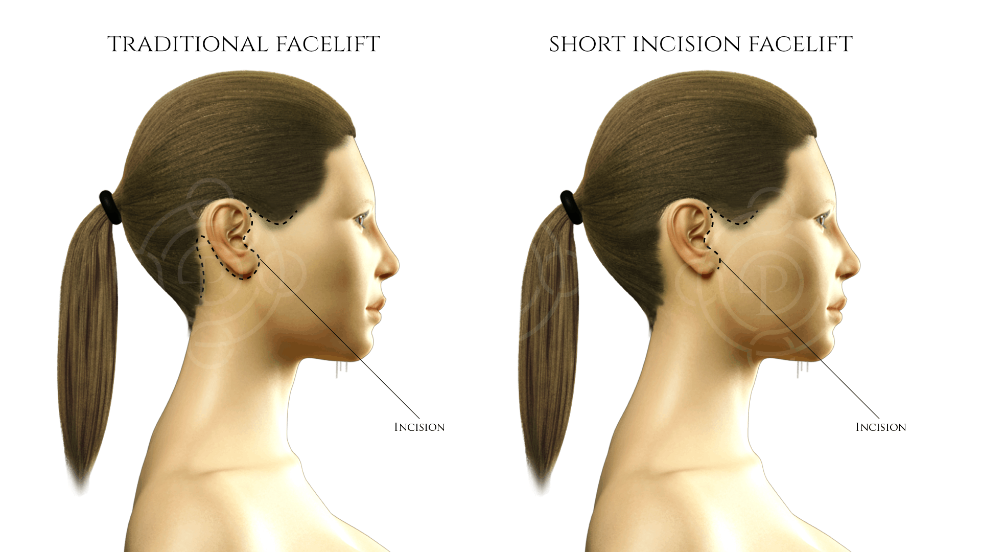 Traditional Facelift vs Short Incision Facelift