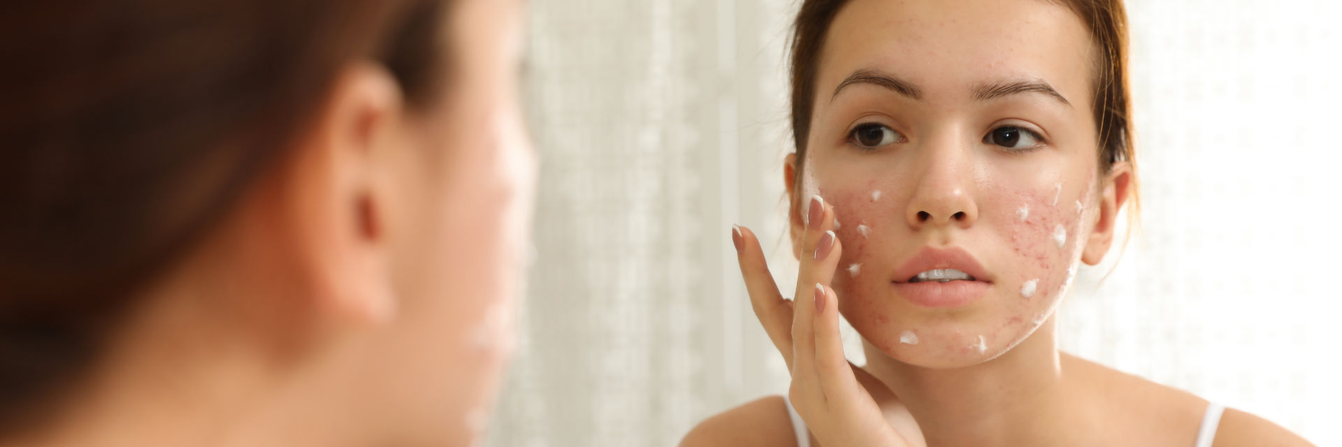 A young woman with acne applying cream on her face.