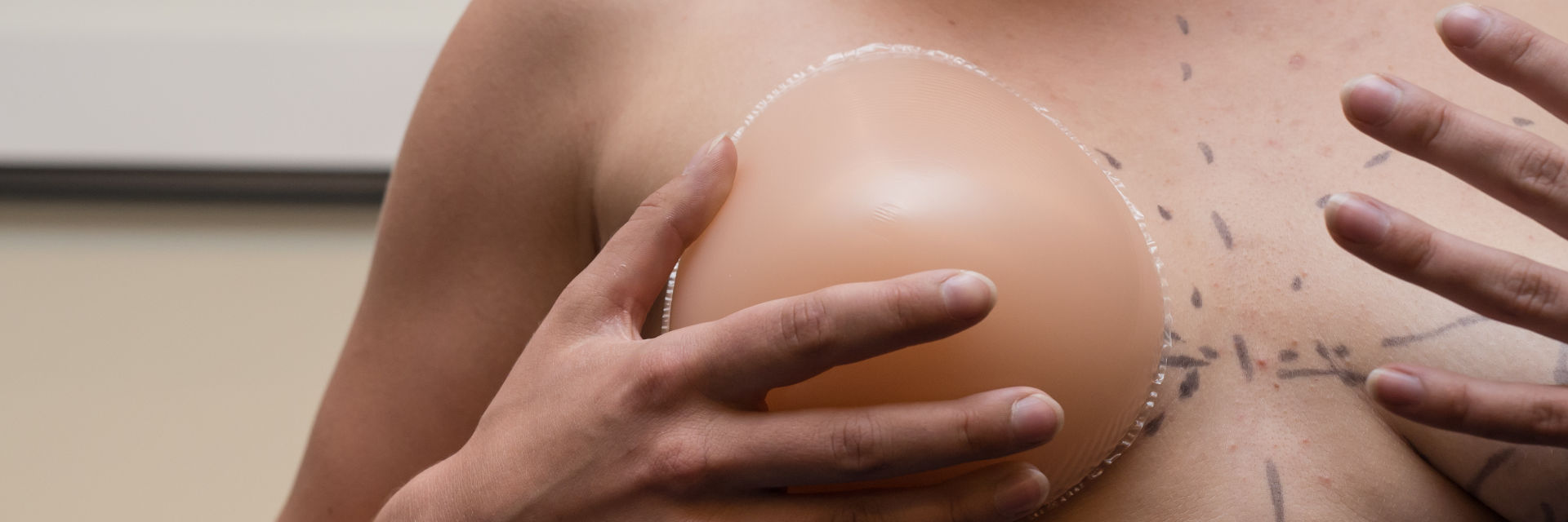 Woman pressing a breast implant to her breasts with pre-operative markings.