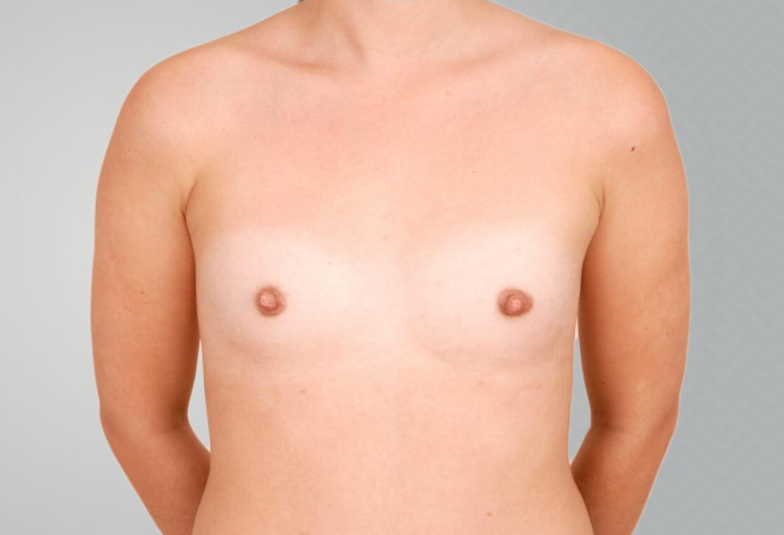 Female patient before breast augmentation procedure..