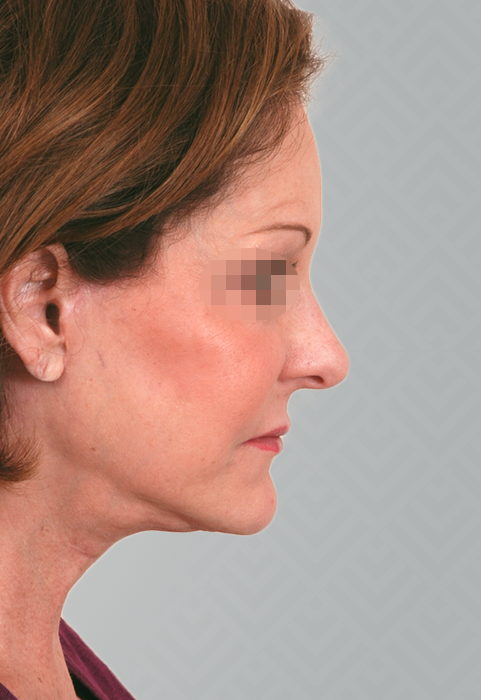 Female patient after facelift and neck lift.