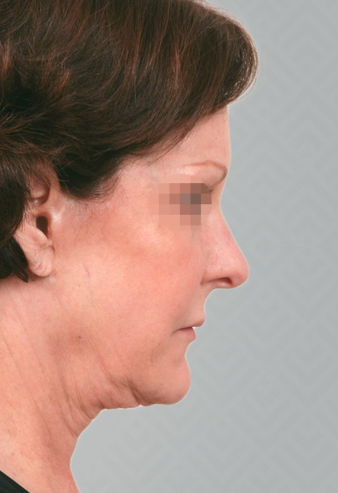 Female patient before facelift and neck lift.