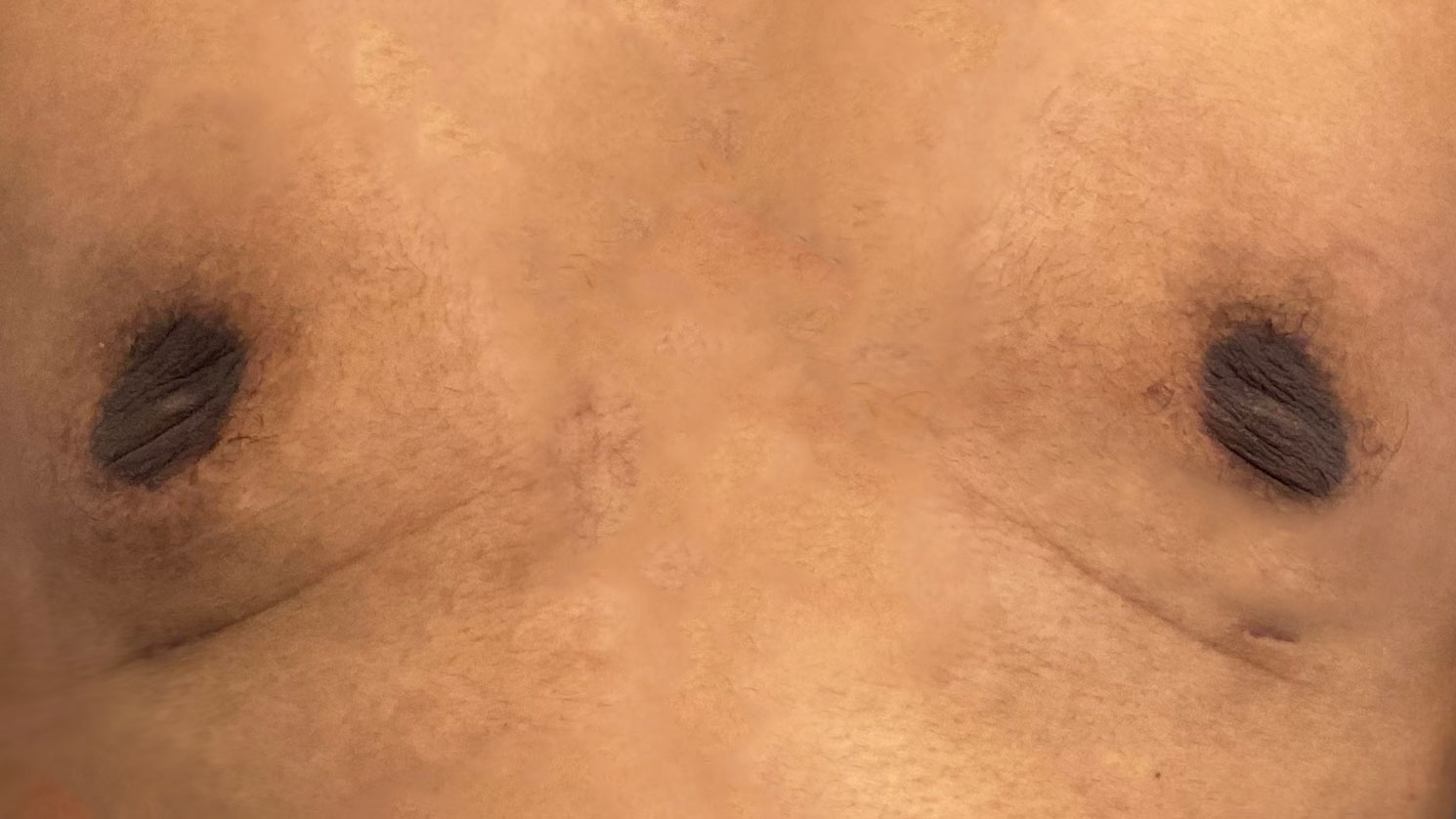 Male patient after gynecomastia treatment.
