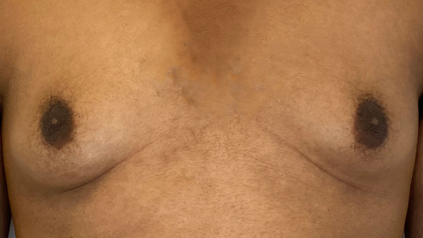 Male patient before gynecomastia treatment.