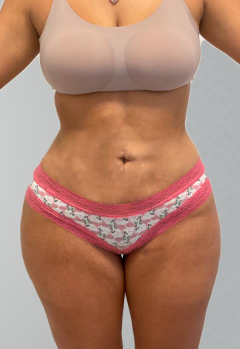 Female patient after liposuction.