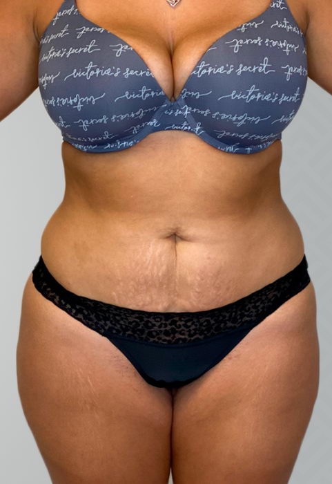 Female patient before liposuction.