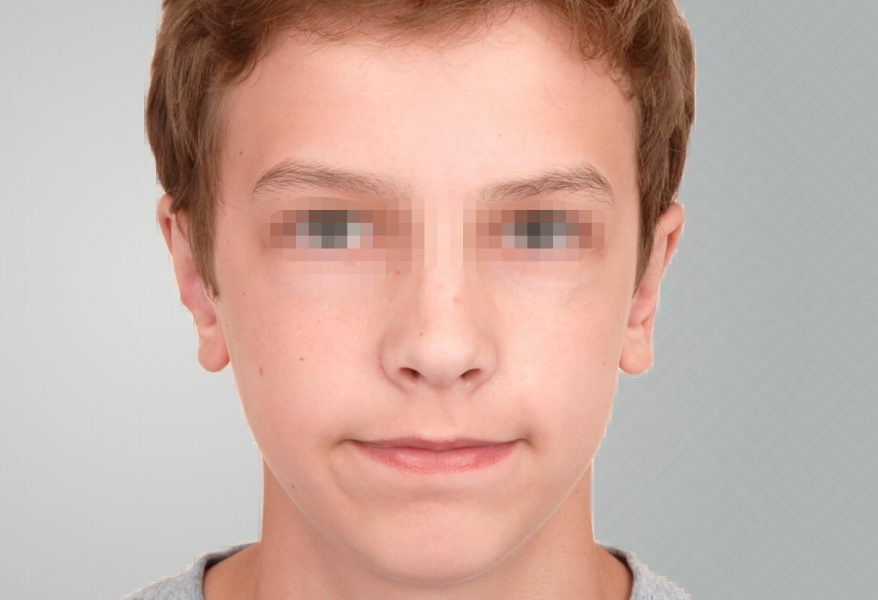 Teenage boy after otoplasty