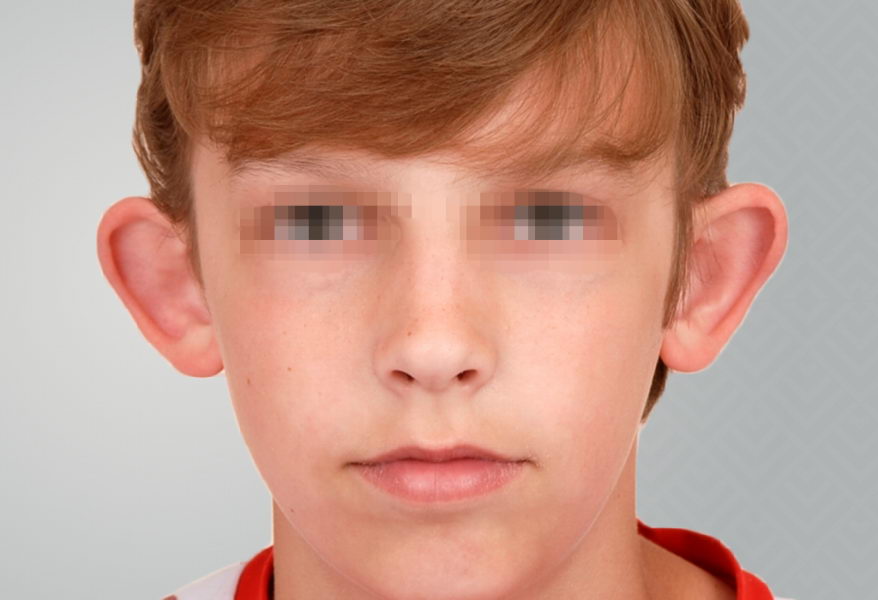 Teenage boy before otoplasty