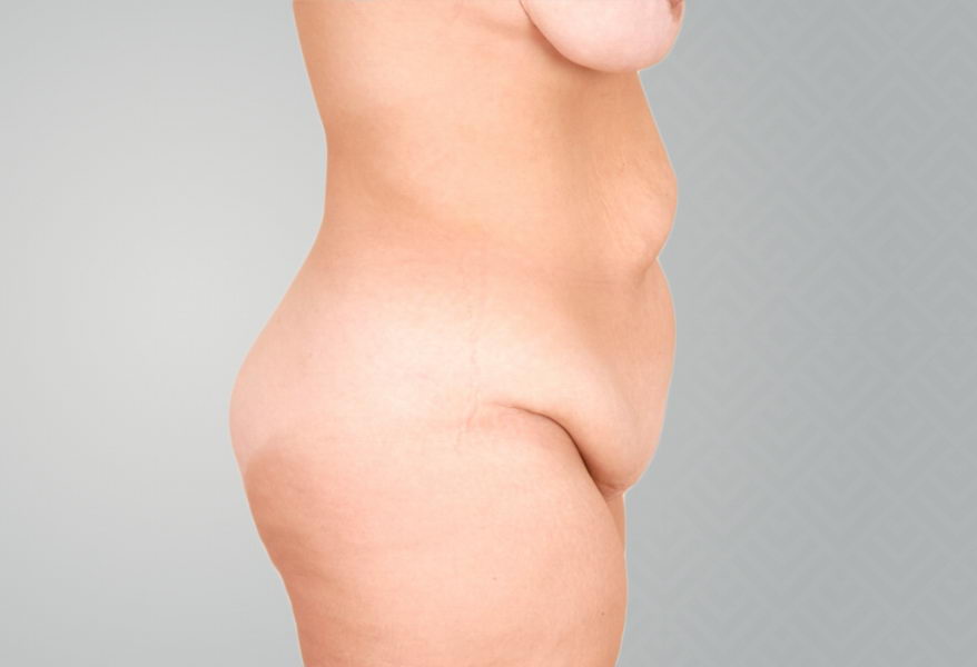 Female patient before tummy tuck.