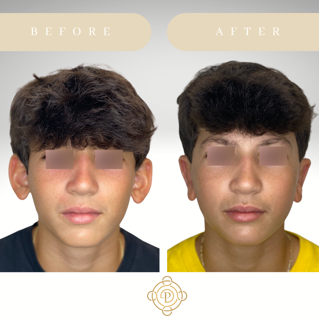 Teenage boy before and after otoplasty.