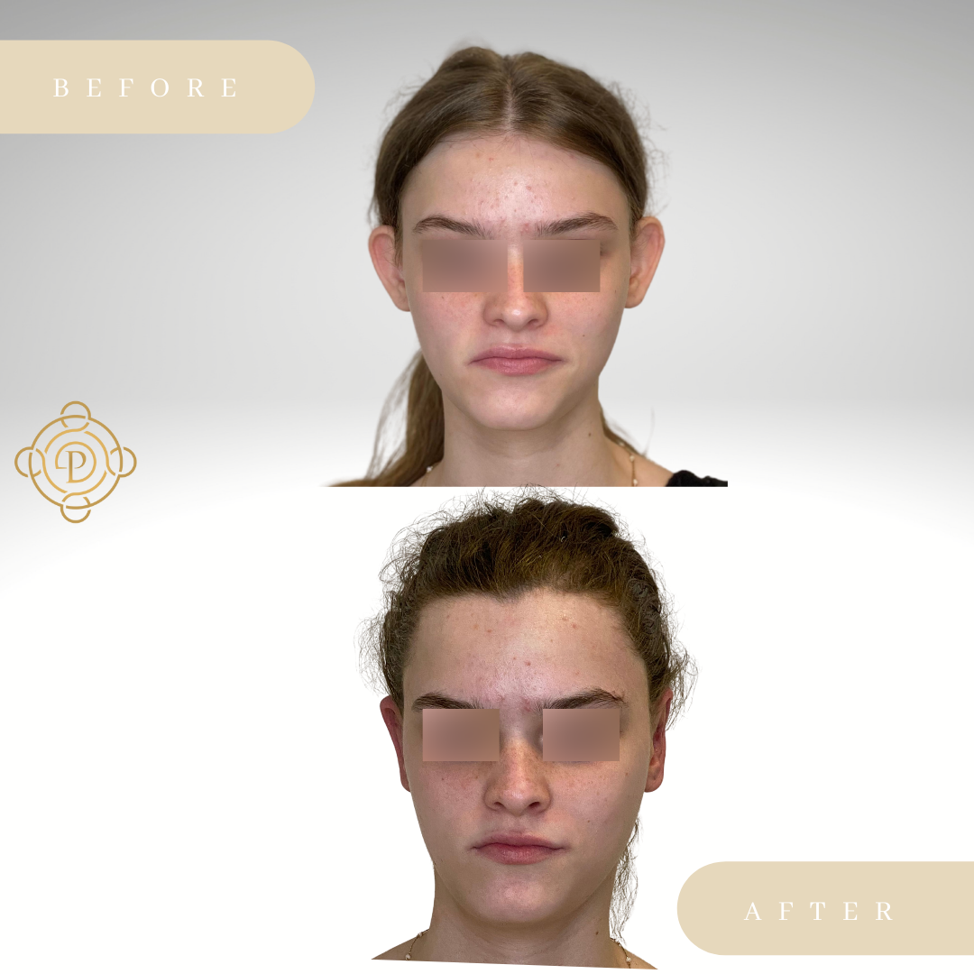 Teenage girl before and after otoplasty.
