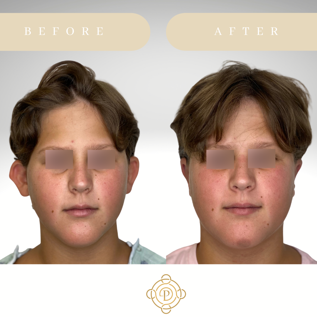 Teenage boy before and after otoplasty.