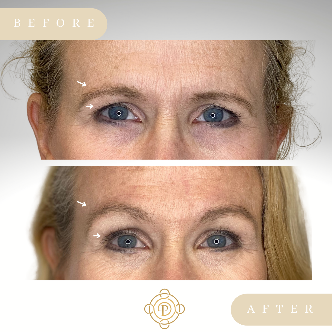 Female patient before and after browlift.