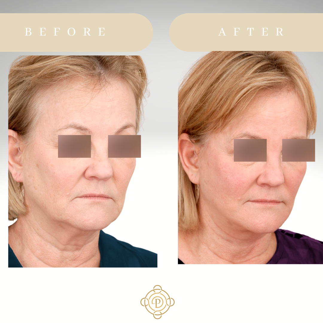 Female patient before and after facelift.