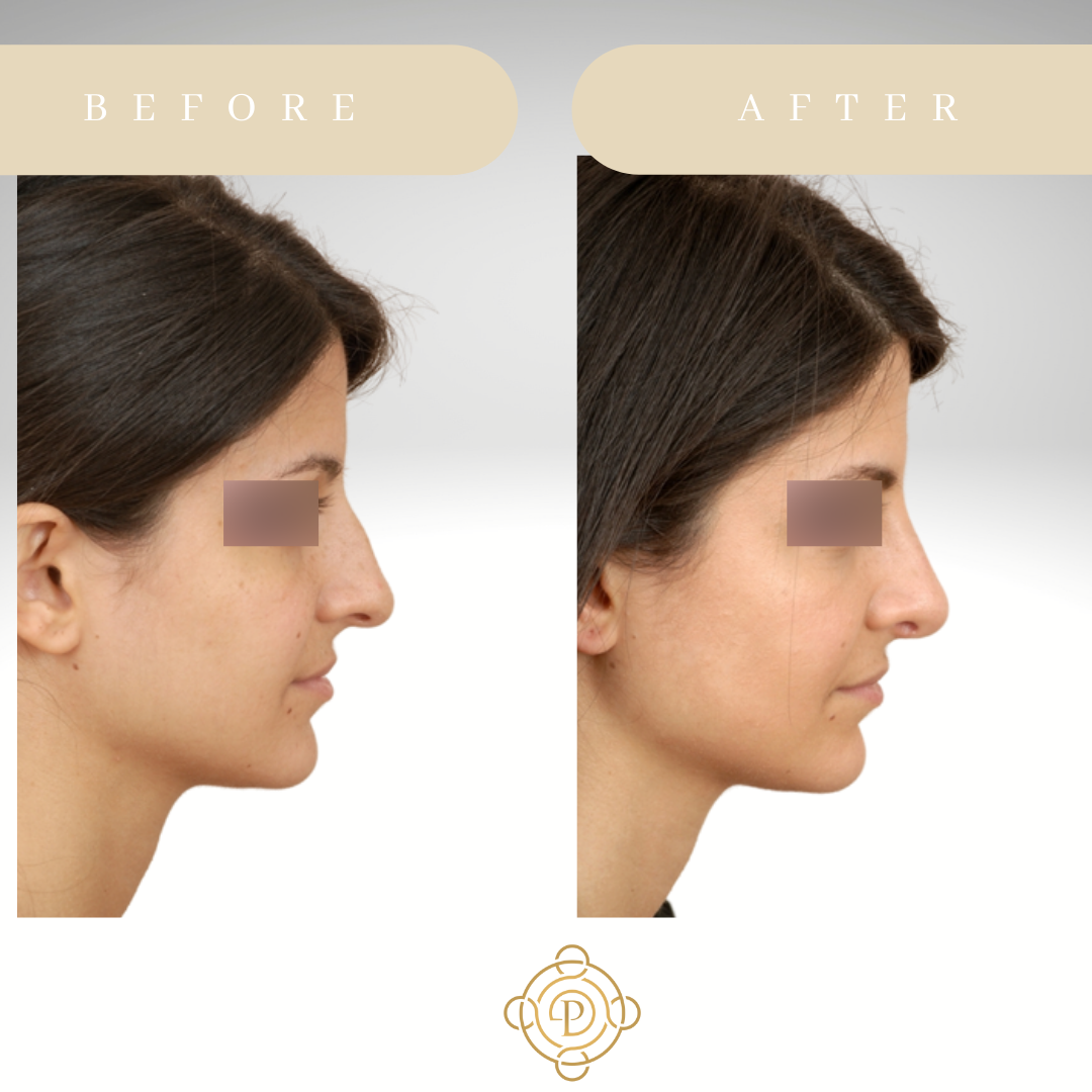 Side view of a female patient before and after rhinoplasty.