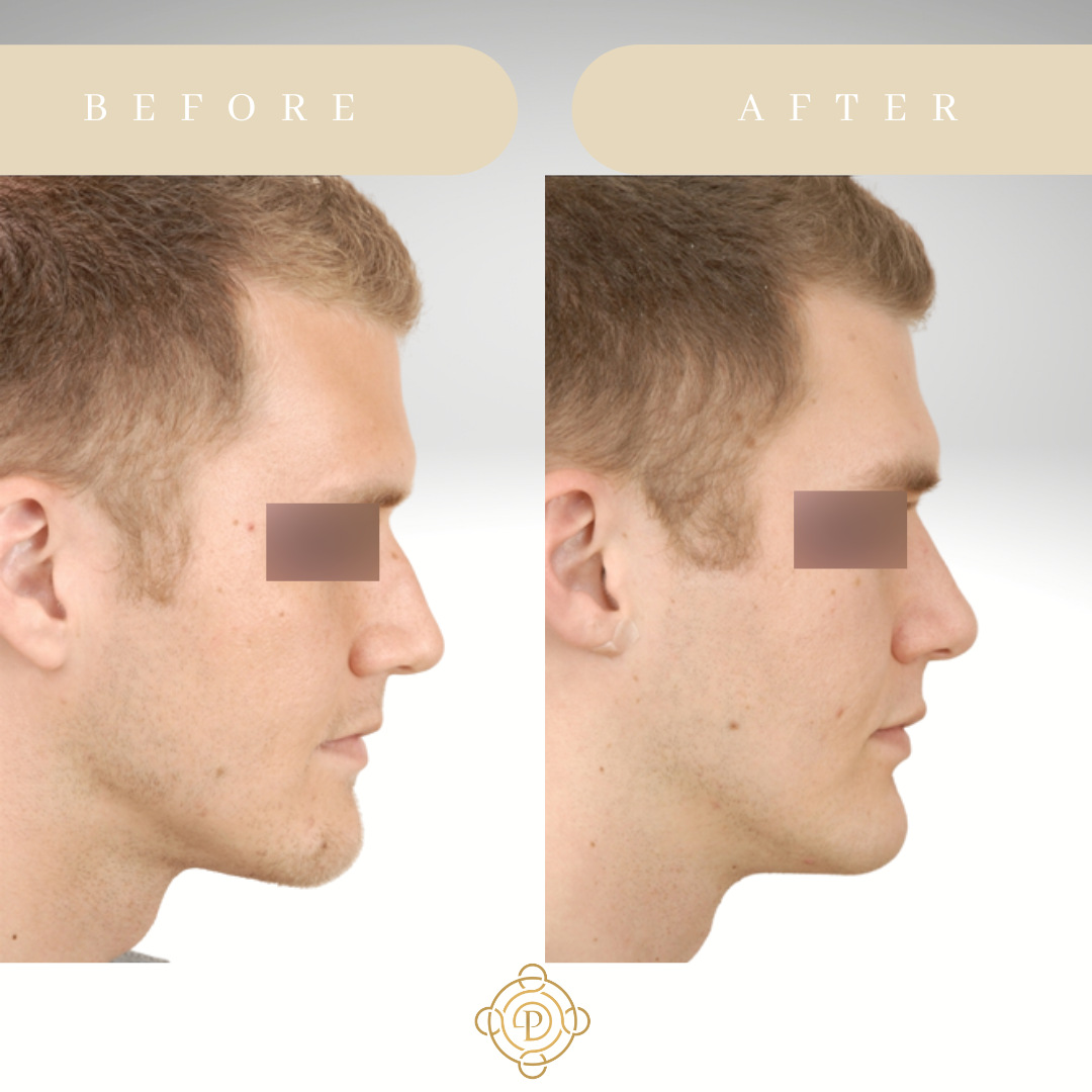 Side view of a male patient before and after rhinoplasty.