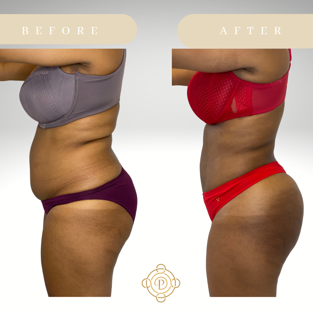Side view of a female patient before and after liposuction and Brazilian Butt Lift..
