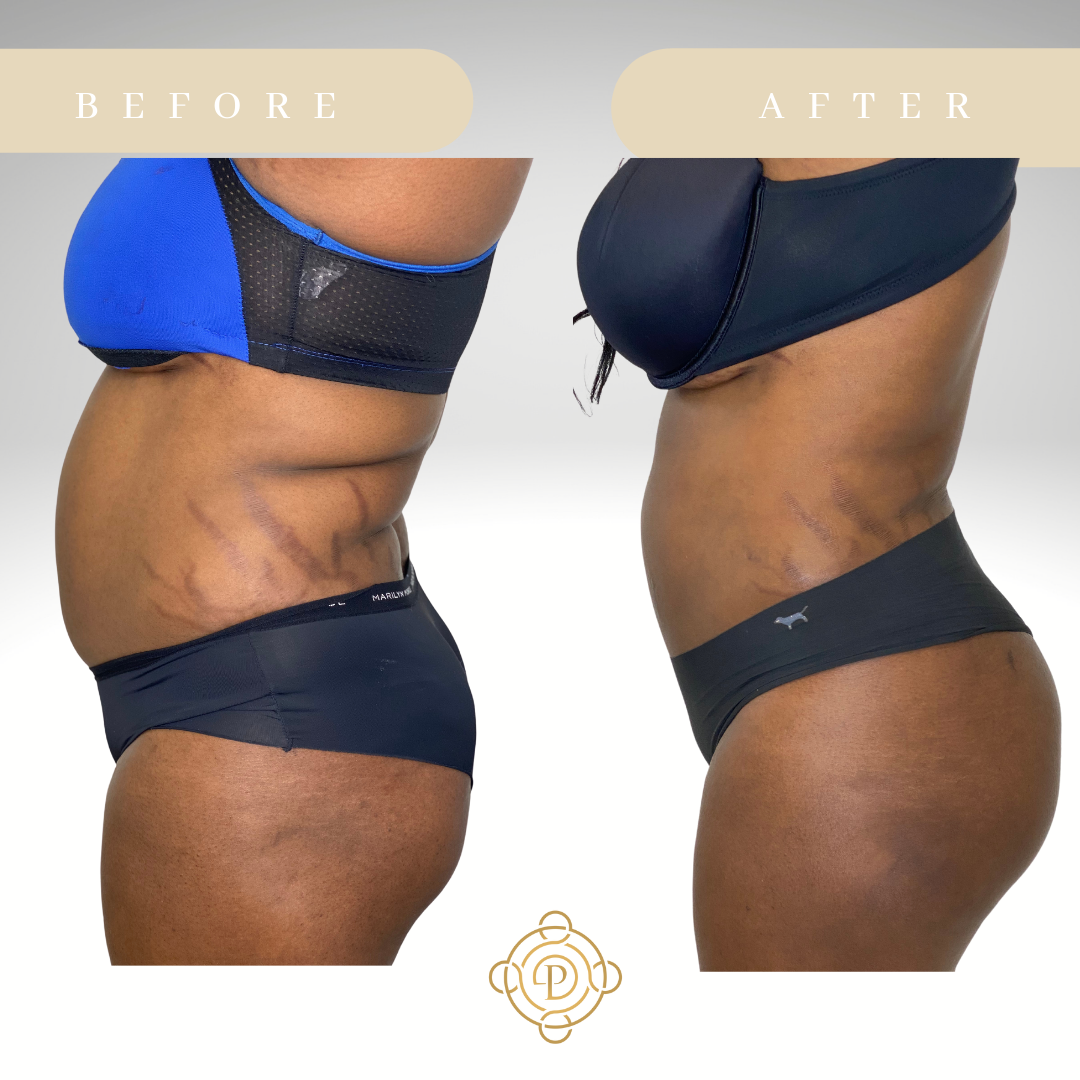 Side view of a female patient before and after liposuction and Brazilian Butt Lift..