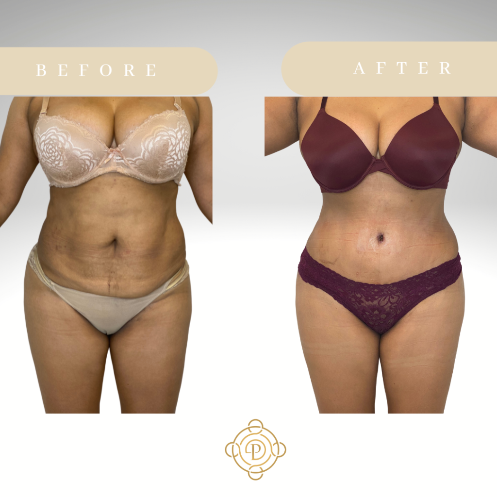 Female patient before and after tummy tuck.